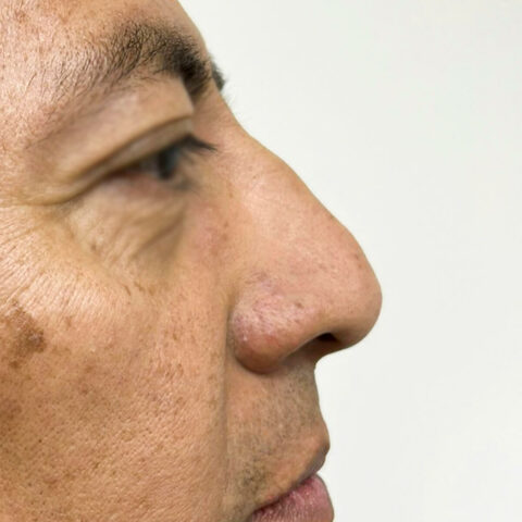 Antes