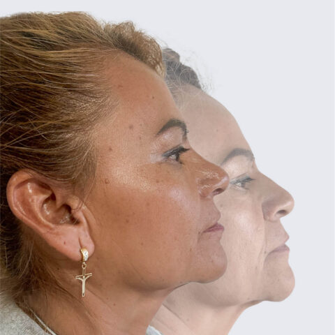 Comparativo antes y después rinoplastía