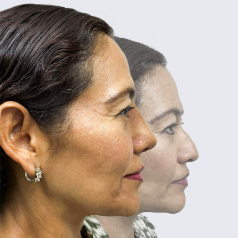 Comparativo antes y después rinoplastía