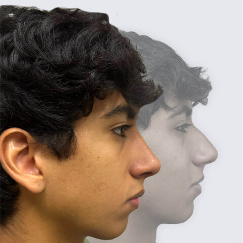 Comparativo antes y después rinoplastía