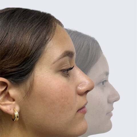 Comparativo antes y después rinoplastía